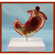 Human Stomach with Ulcers Anatomical Model